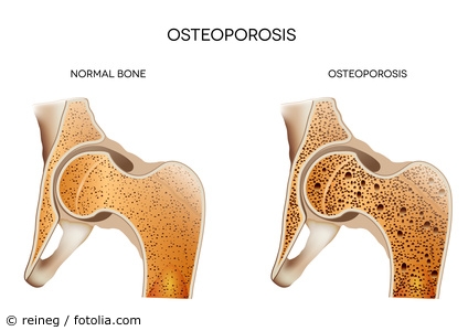 Osteoporose 424
