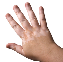 vitiligo axel bueckert fotolia